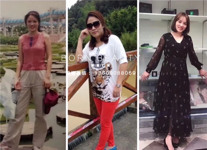 冰丝埋线减肥原理