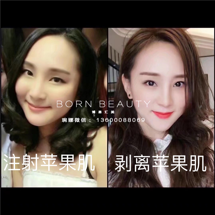 苹果肌剥离术是什么