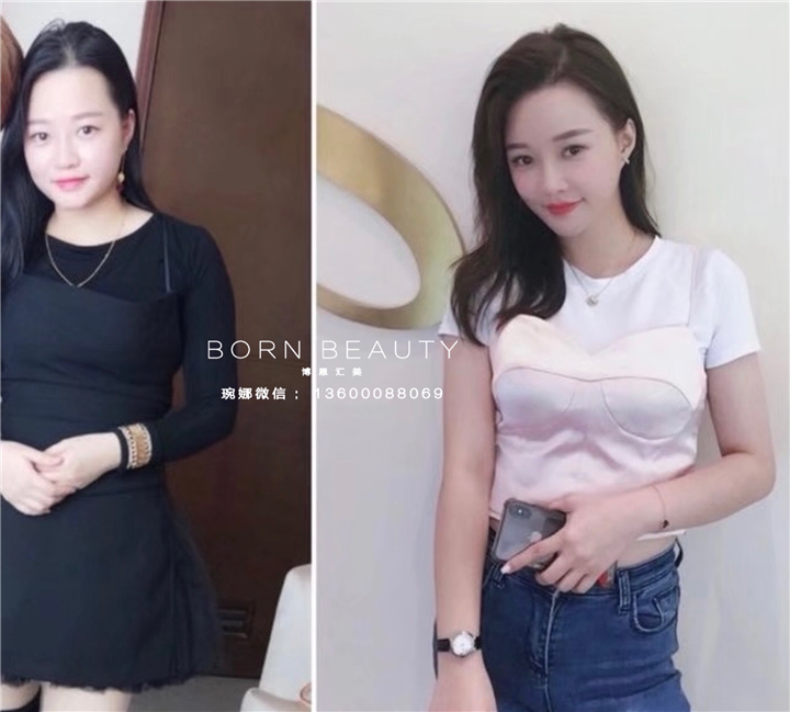 冰丝埋线减肥价格