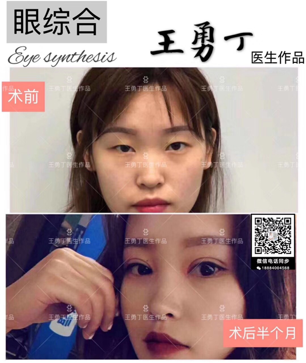 王勇丁眼部整形