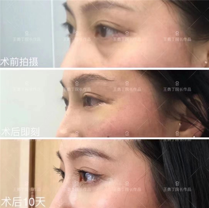 成都眼袋整形专家