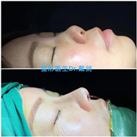 南京鼻整形医生