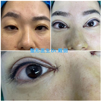 南京戴剑医生做双眼皮