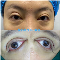 南京眼部整形