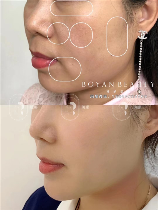 印第安老化下垂解决思路