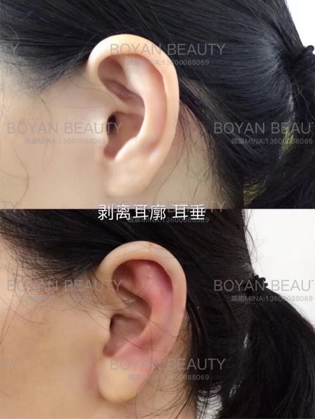 剥离耳廓耳垂 