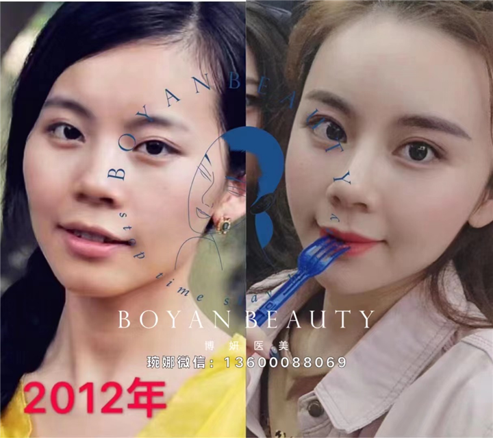 博妍剥离微雕抗衰
