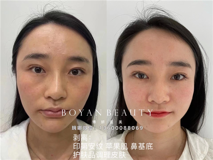 深圳剥离印第安纹 苹果肌 鼻基底