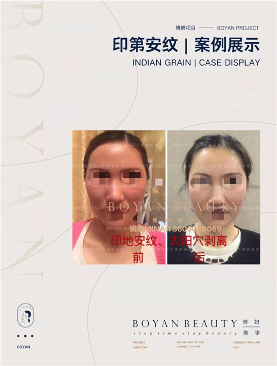 印第安纹剥离
