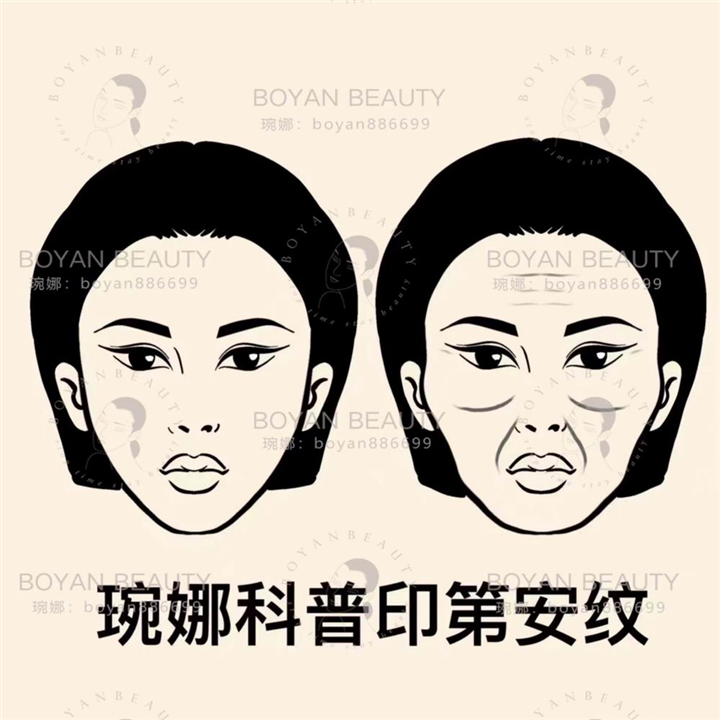 印第安纹剥离