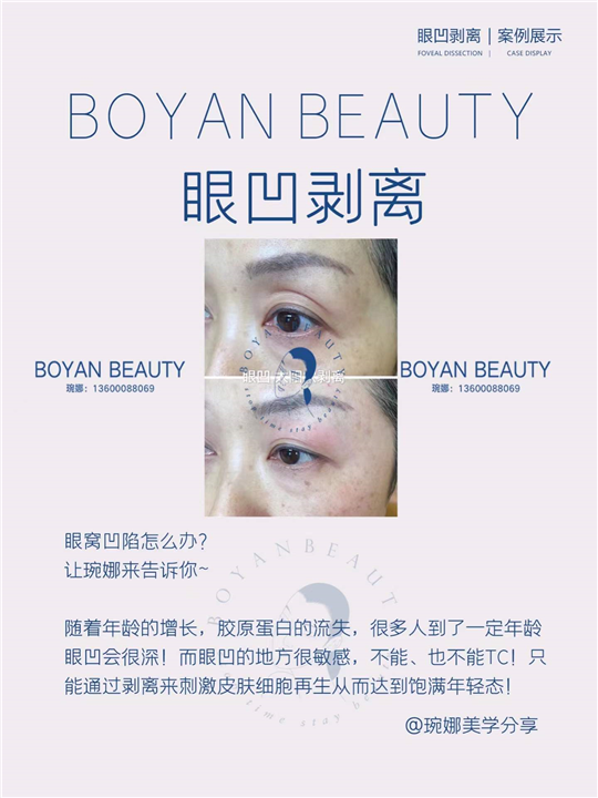 眼凹剥离