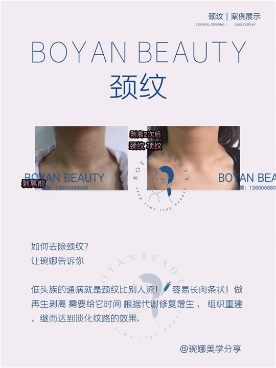 剥离颈纹