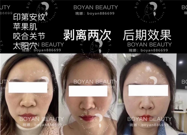 博妍剥离微整