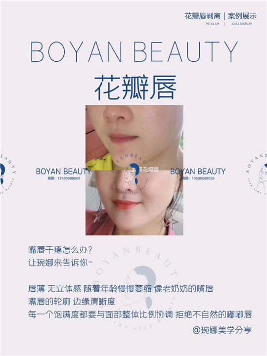 剥离花瓣唇