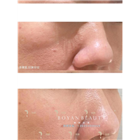 印第安纹怎么解决