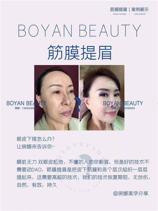 筋膜提眉