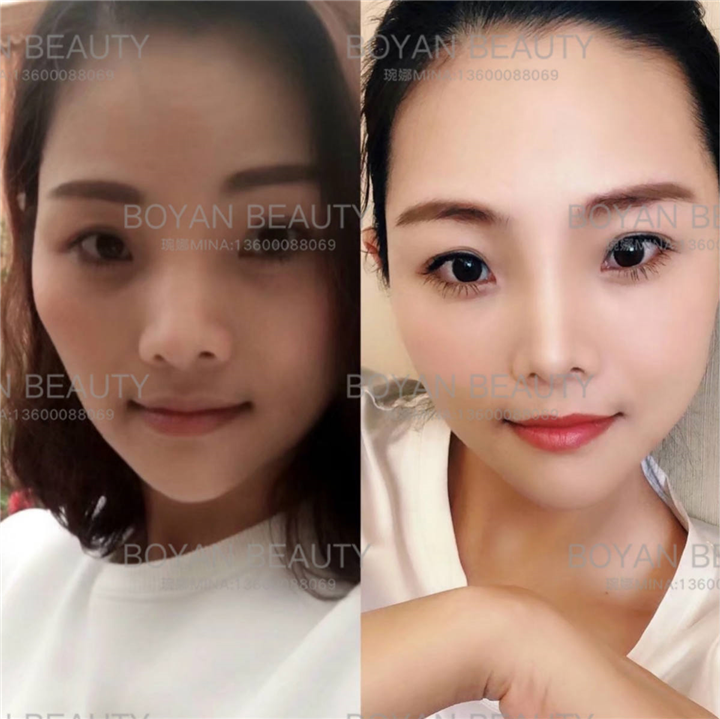 剥离咬合关节