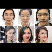 印第安纹剥离微整