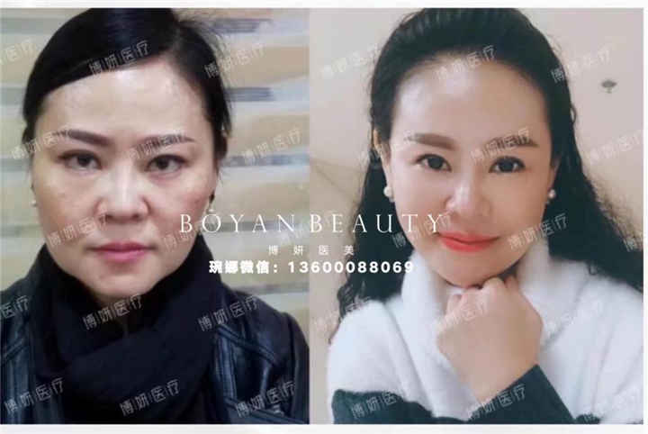 博妍剥离微整