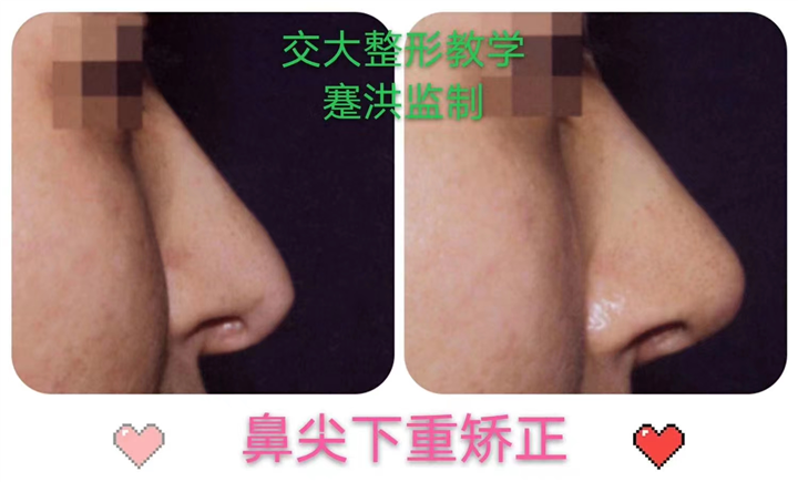 蹇洪医生鼻尖下垂矫正