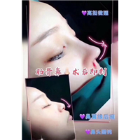 上海肋骨鼻整形