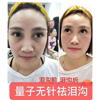 学量子无针微整好不好 