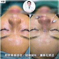 郑志敏肋软骨鼻综合修复20年硅胶鼻