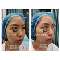 邱志龙医师隆鼻案例