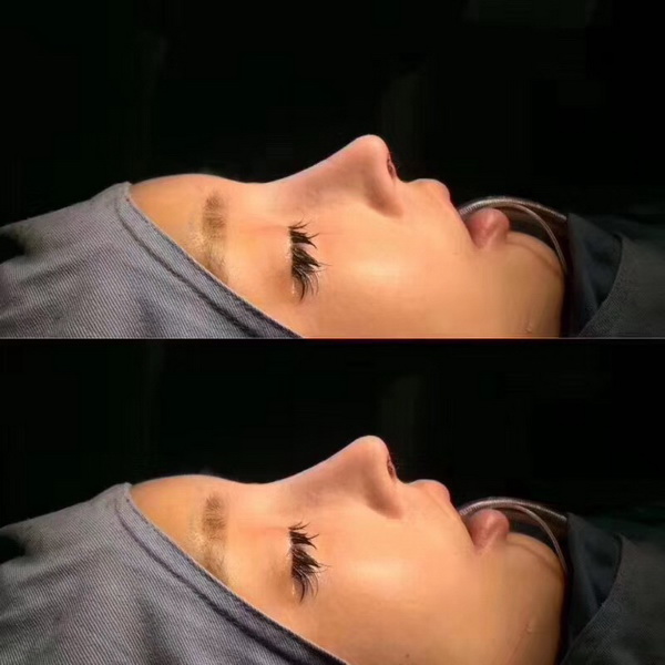 北京眼整形修复专家