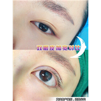 刘阳阳院长眼部整形 