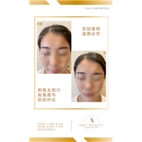 汕头剥离微雕