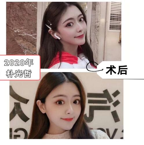 朴光哲磨骨怎么样