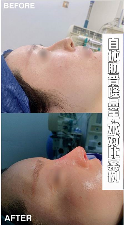 南昌鼻综合整形