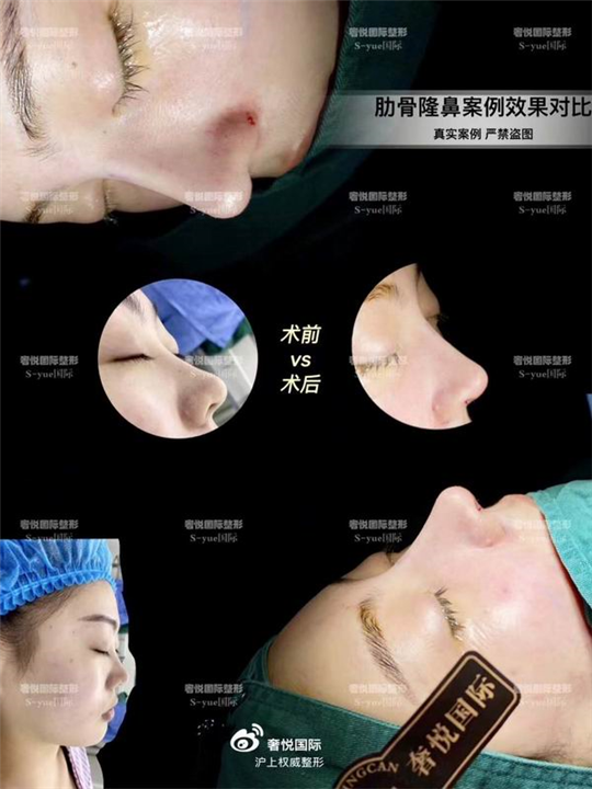 上海鼻综合整形