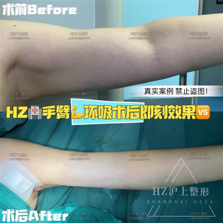 沪上手臂抽脂整形