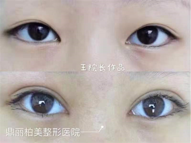 乌鲁木齐割双眼皮