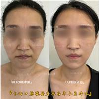 高二青医生:小切口筋膜提升术后半个月对比