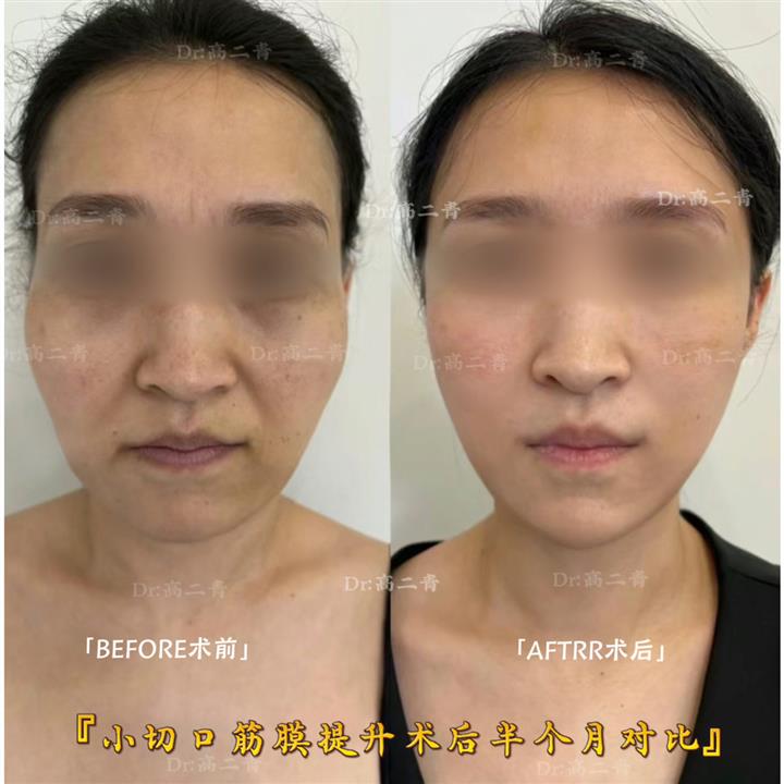 高二青医生:小切口筋膜提升术后半个月对比