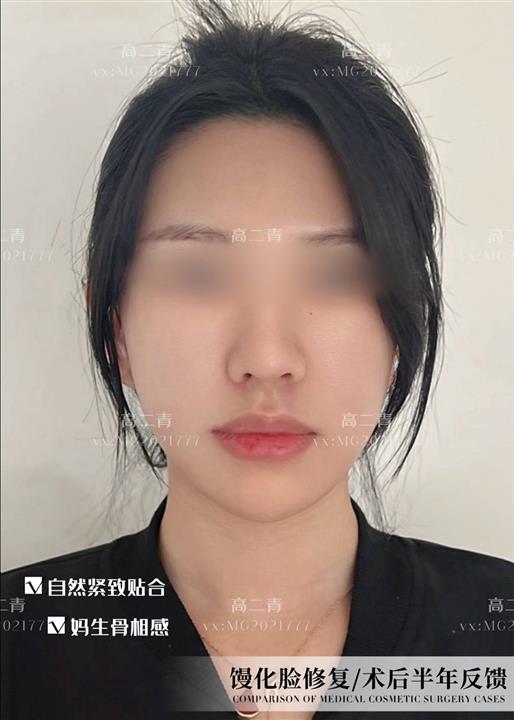 上海高二青医生馒化脸修复