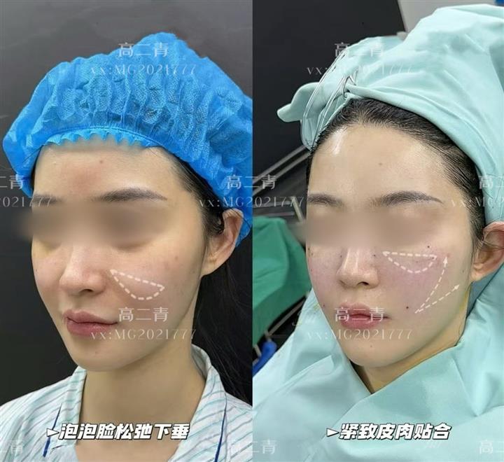 上海面部提升整形高二青