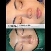 郑志敏医生半肋鼻综合改善短塌鼻