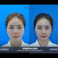 郑志敏半肋综合.自然妈生鼻打造