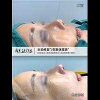 郑志敏医生全肋修复L型膨体隆鼻短鼻延长
