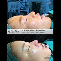 郑志敏鼻整形医生增生型大鼻头修复矫正