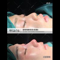 郑志敏医生半肋鼻综合术后即可