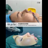郑志敏医生半肋鼻综合臃肿大鼻头修复