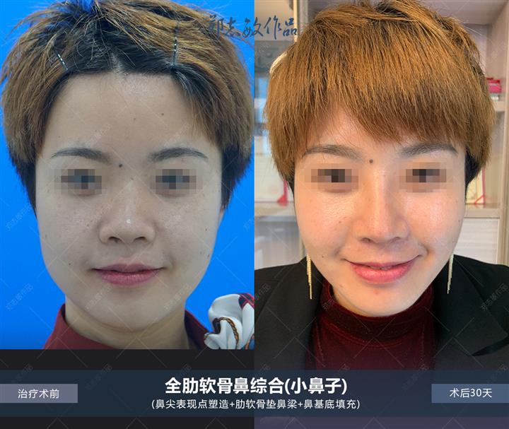 全肋鼻综合改善小鼻子症