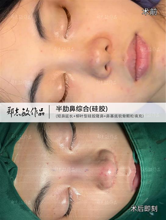 郑志敏医生半肋鼻综合改善短塌鼻
