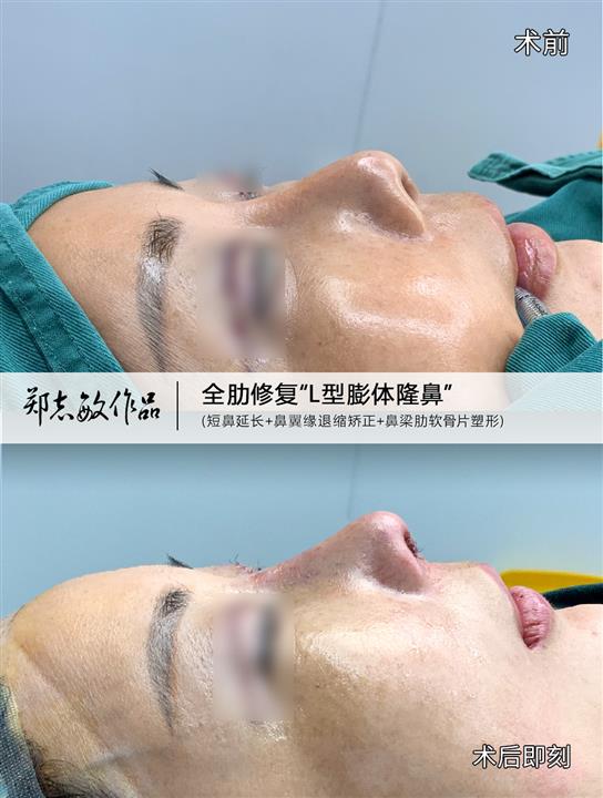 郑志敏医生全肋修复L型膨体隆鼻短鼻延长