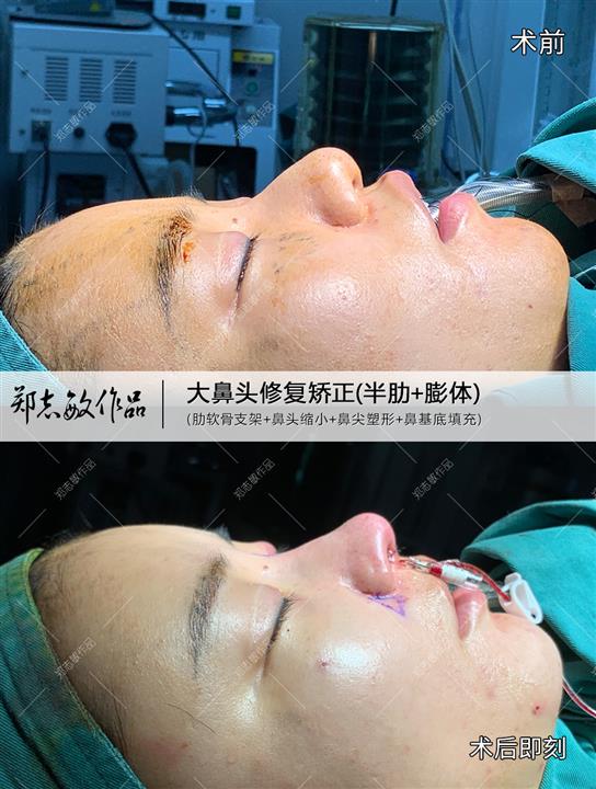 郑志敏鼻整形医生增生型大鼻头修复矫正